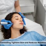 RF Microneedling