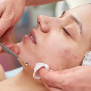 Facials acne treatment