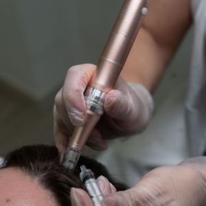 hair fall treatment