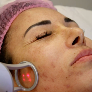laser treatment