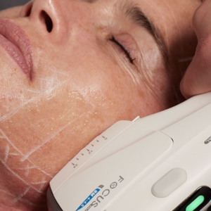 microneedling dermapen