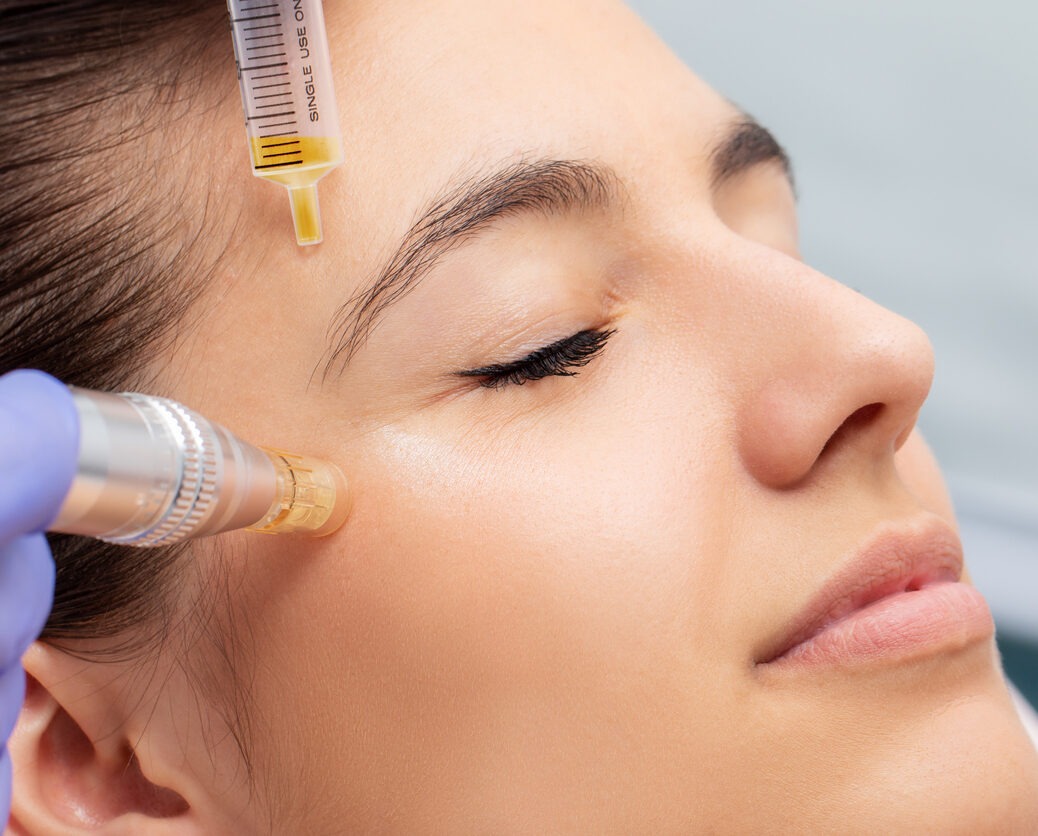 woman having micro needling treatment reducing crow's feet