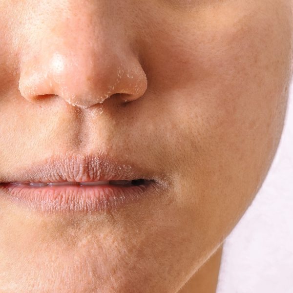 Allergic women have eczema dry nose and lips on winter season closeup.