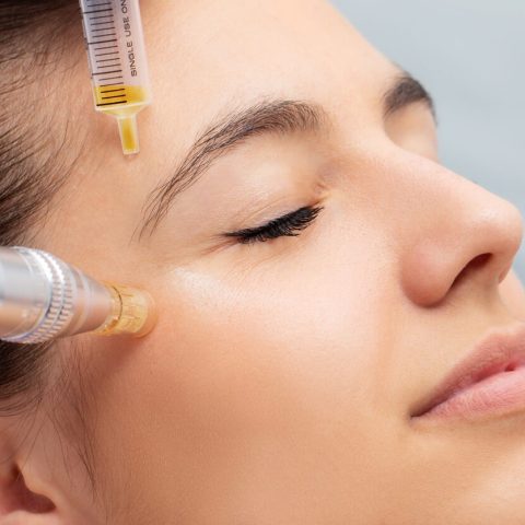 microneedling e1719057284884.jpg