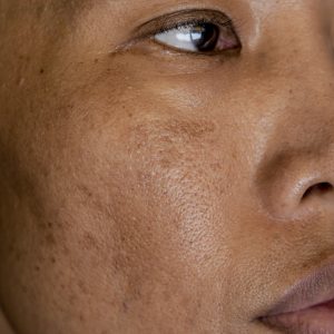 Freckles and Spot melasma pigmentation skin facial treatment over Asian woman face.Wrinkles, melasma, Dark spots, freckles, dry skin.Problem skincare and health concept. Before and after